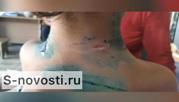 В Астрахани ребёнок попал в реанимацию после нападения собак
